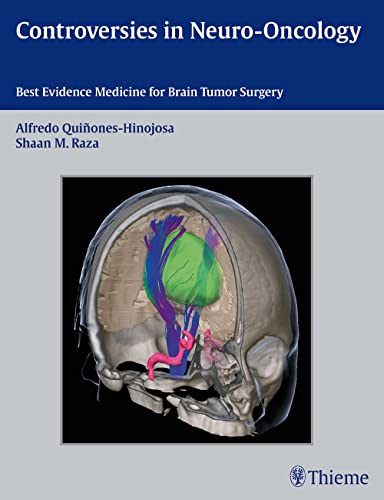 Controversies in Neuro-Oncology 1st Edition 2014