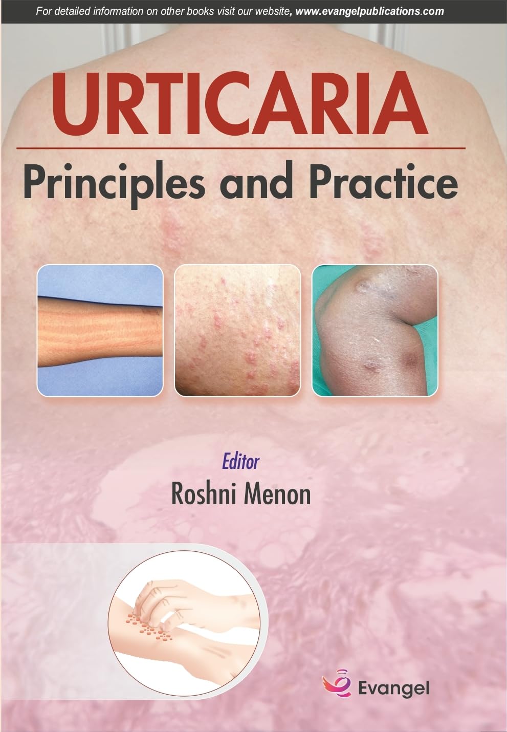 Urticaria Principal and Practice