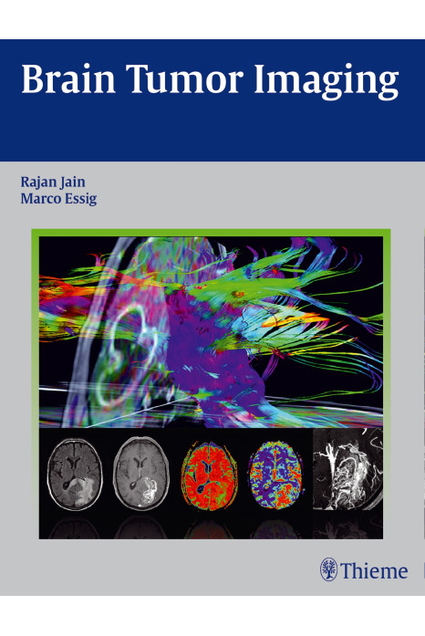 Brain Tumor Imaging 1st Edition 2015