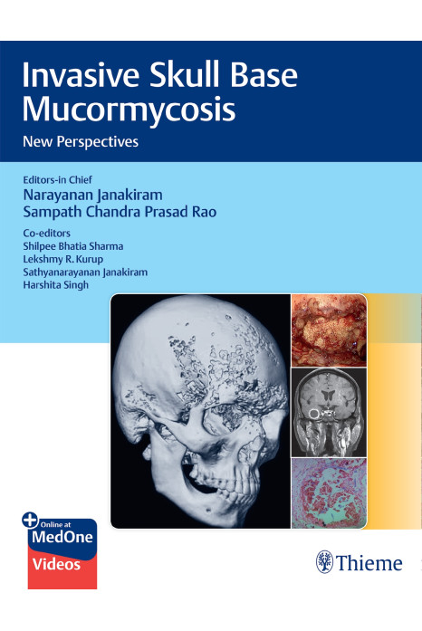 Invasive Skull Base Mucormycosis 1st Edition 2022