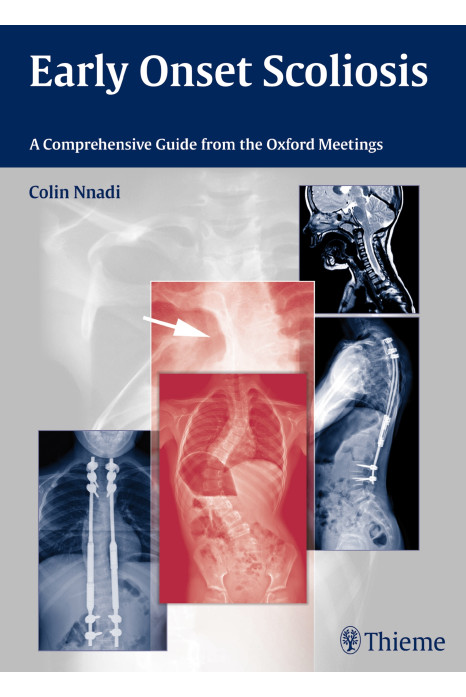 Early Onset Scoliosis A Comprehensive Guide from the Oxford Meetings 1st Edition 2015