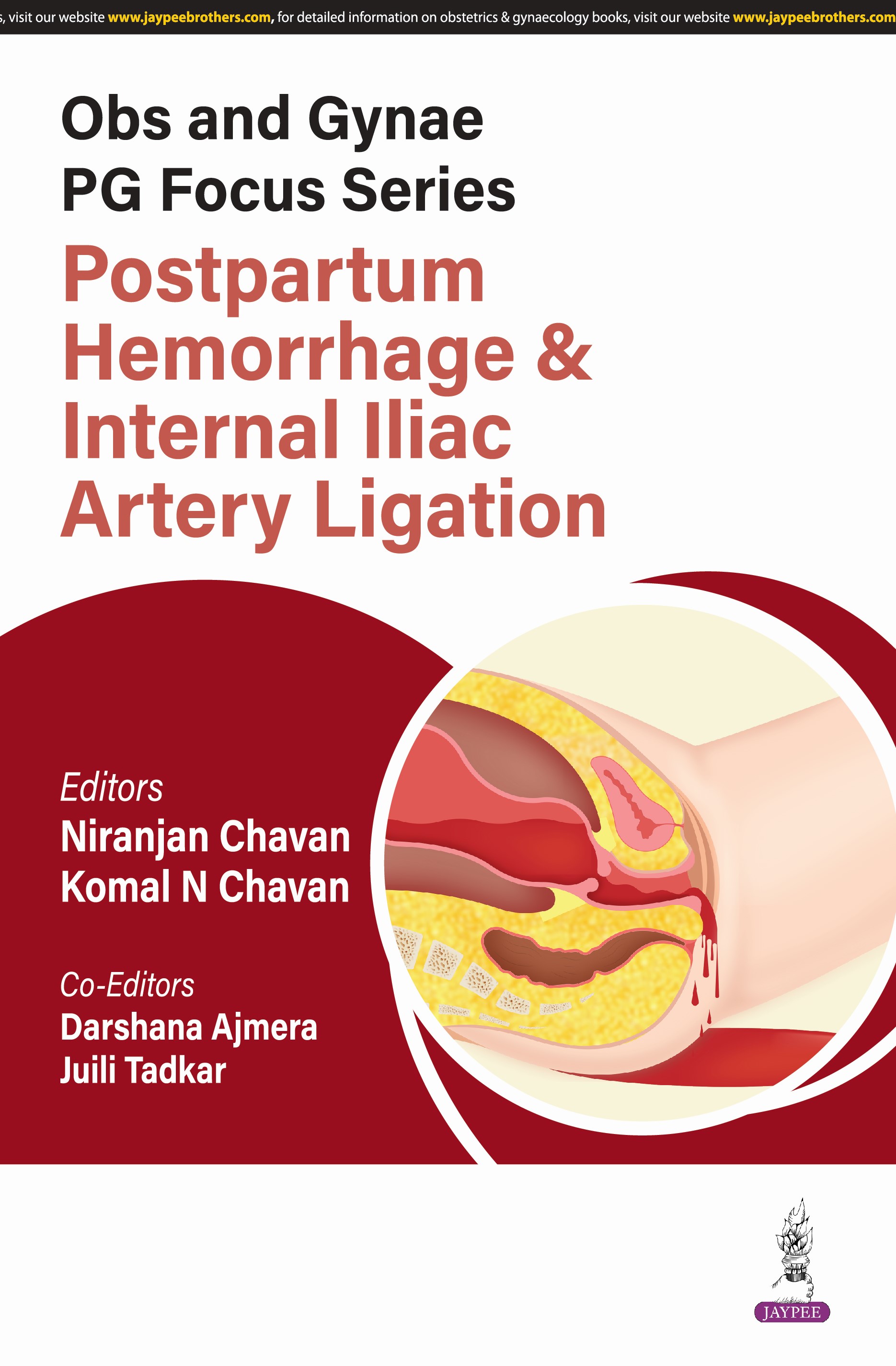 OBS AND GYNAE PG FOCUS SERIES POSTPARTUM HEMORRHAGE AND INTERNAL ILIAC ARTERY LIGATION