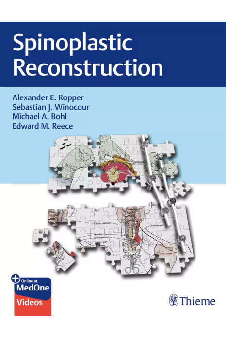 Spinoplastic Reconstruction (Hb 2024)