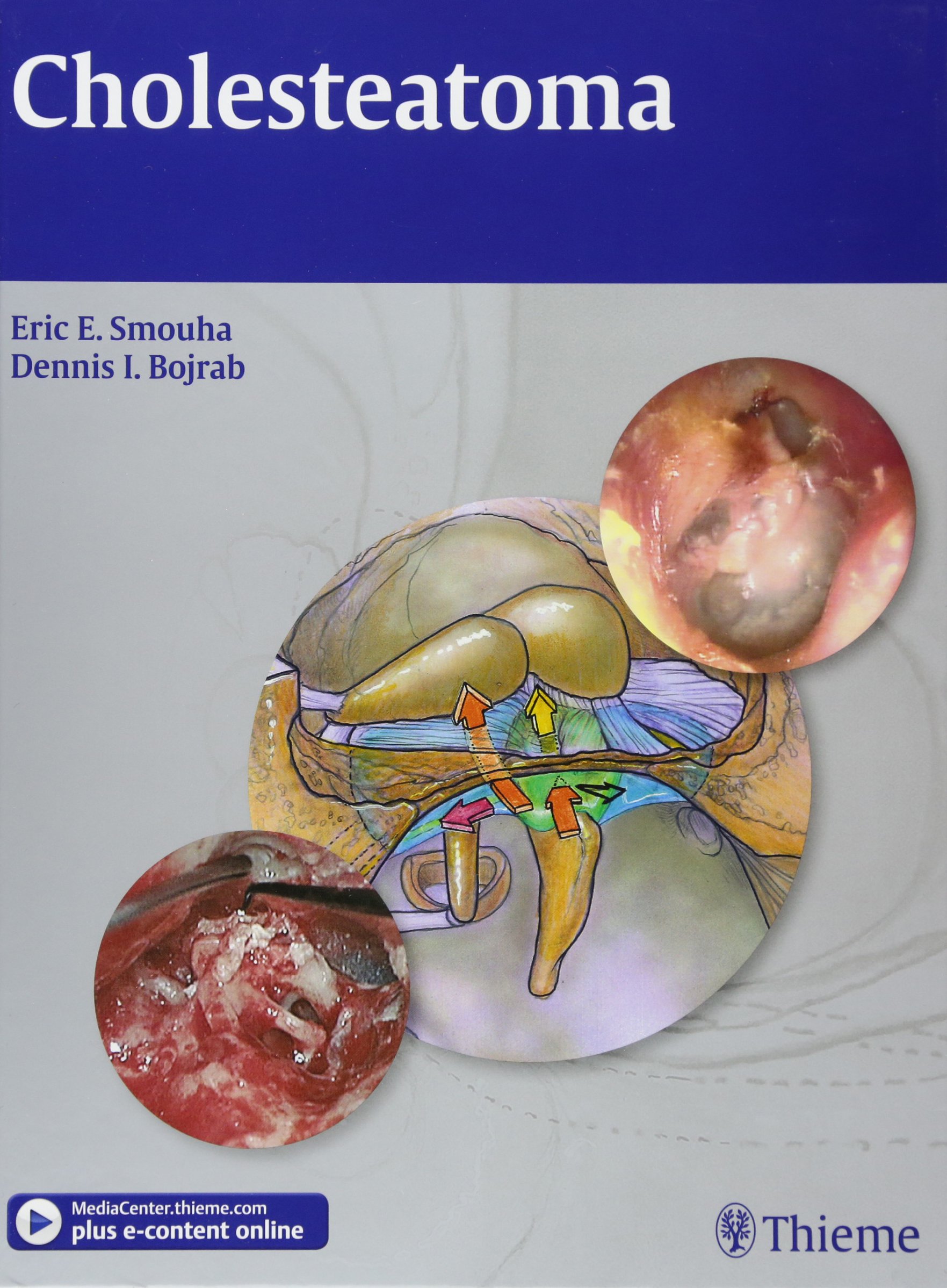 Cholesteatoma 1st Edition 2012