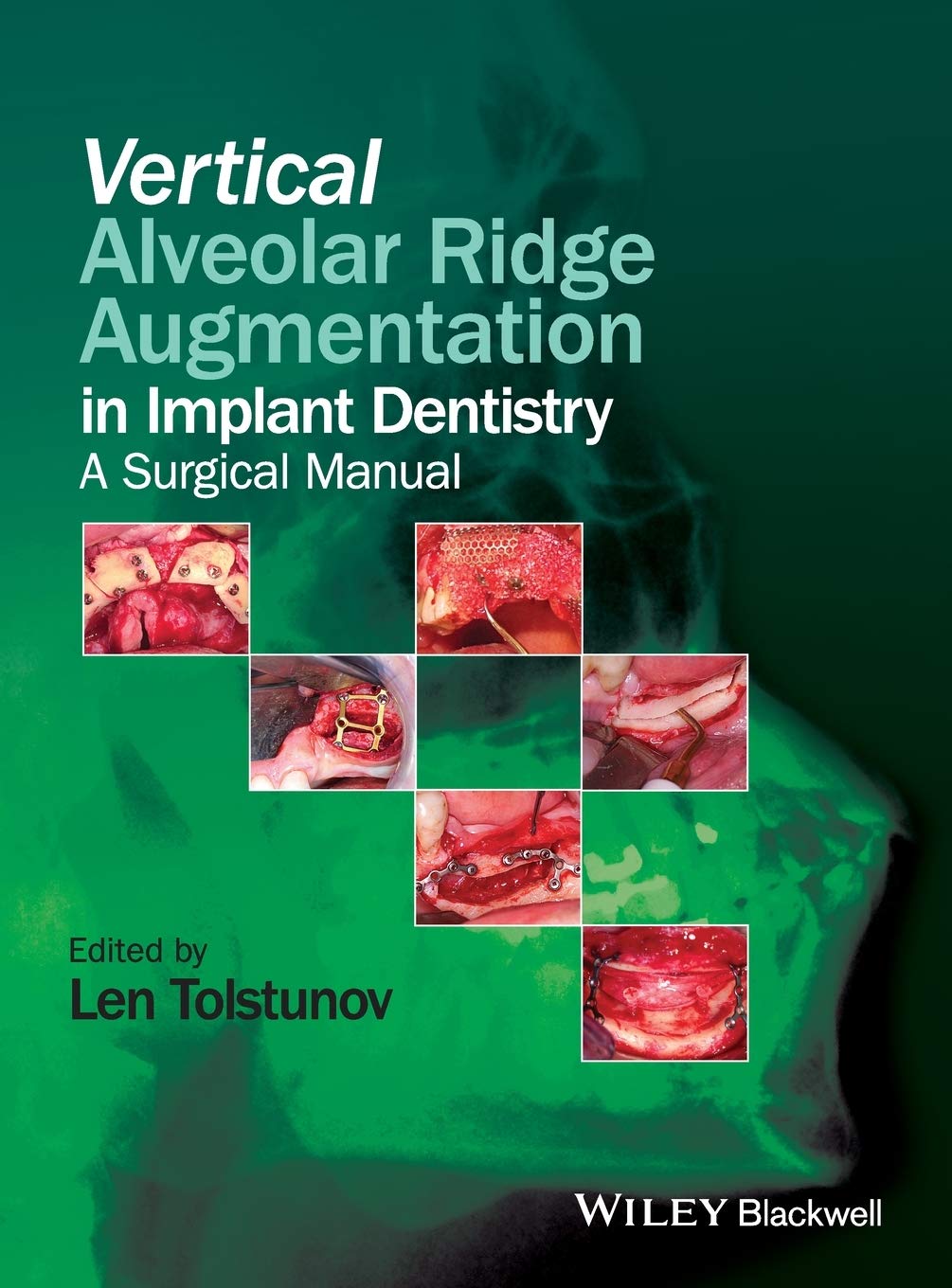 Vertical Alveolar Ridge Augmentation In Implant Dentistry A Surgical Manual (Hb 2016)