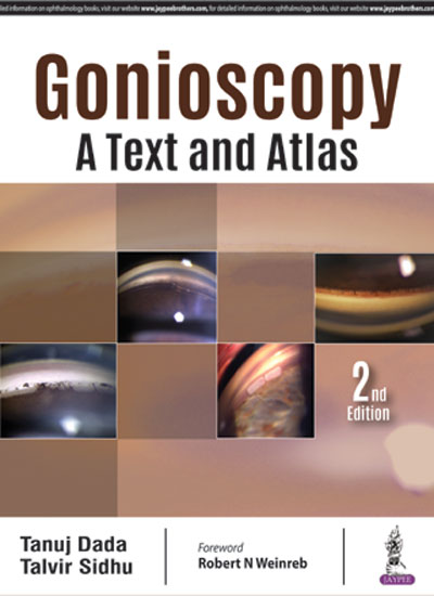 Gonioscopy:A Text And Atlas