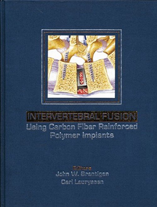 Intervertebral Fusion Using Carbon Fiber Reinforced Polymer Implants 1st Edition 2006