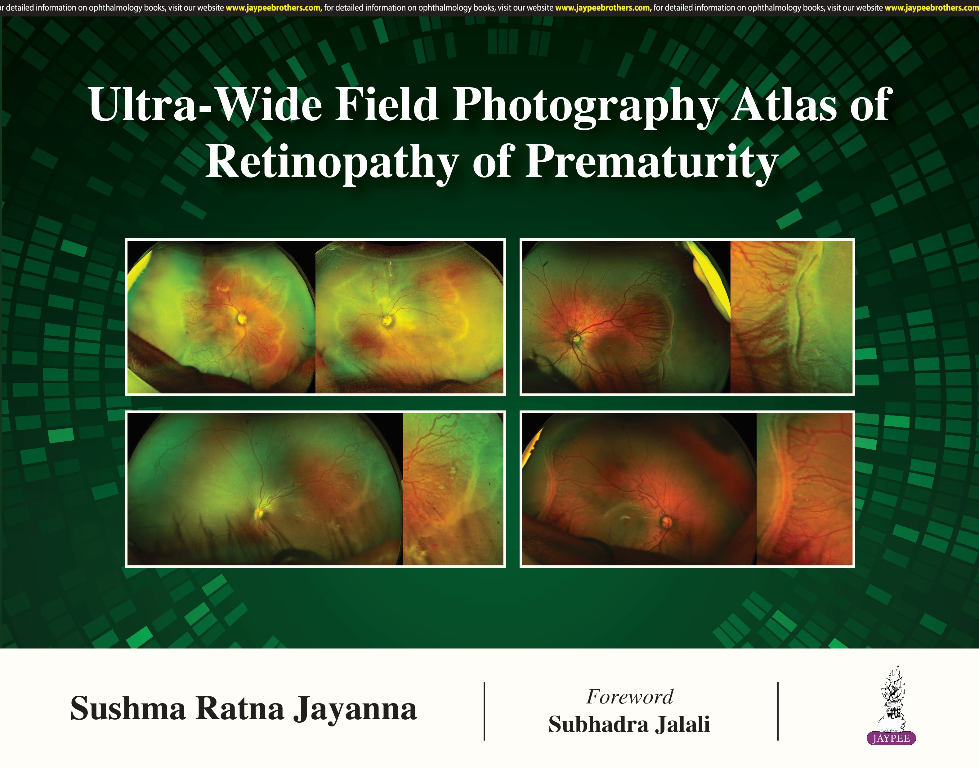 Ultra- Wide Field Photography Atlas Of Retinopathy Of Prematurity