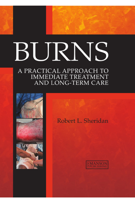 Burns A Practical Approach To Immediate Treatment And Long Term Care