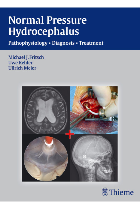 Nph - Normal Pressure Hydrocephalus Pathophysiology - Diagnosis - Treatment
