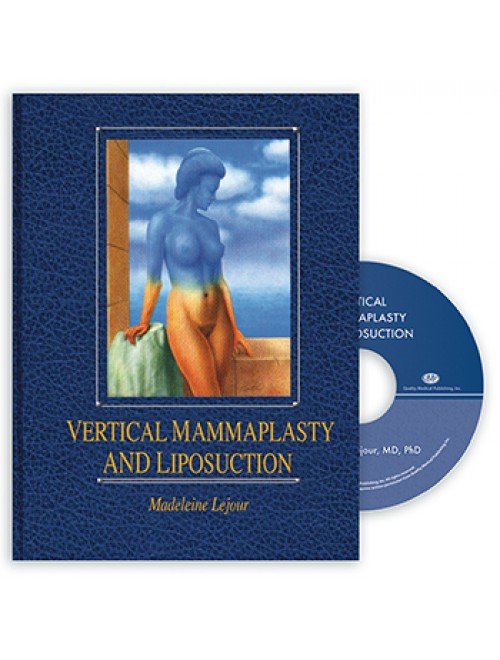 Vertical Mammaplasty and Liposuction 1st Edition 1994