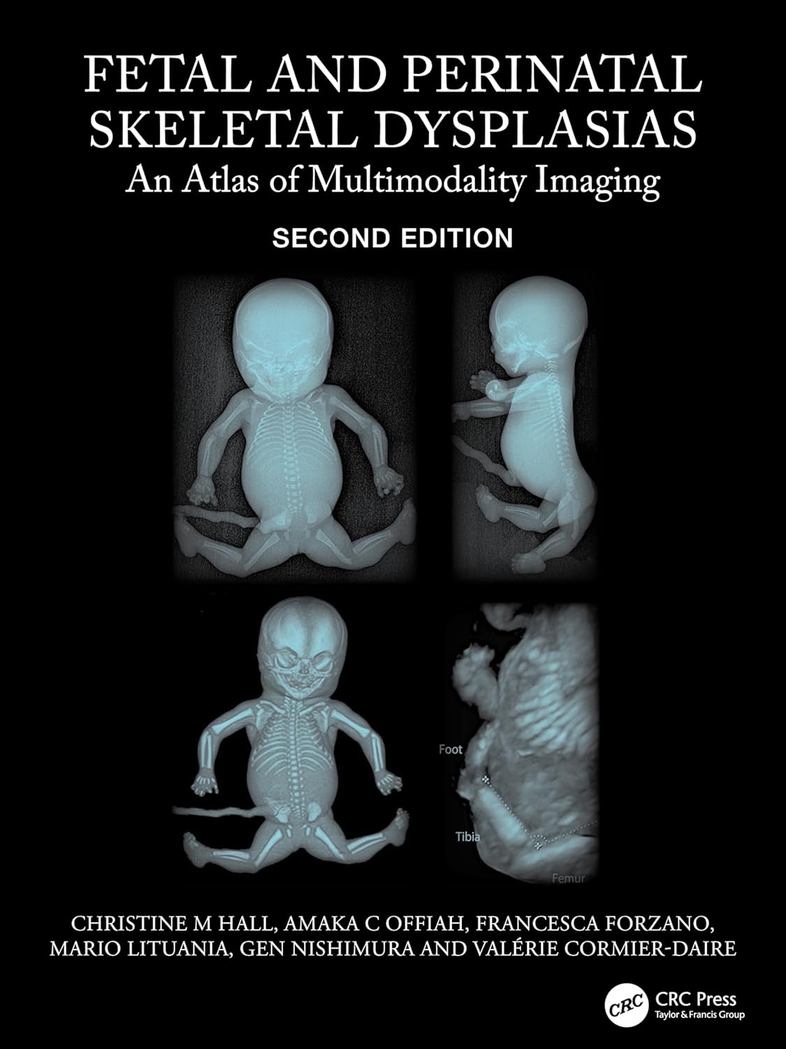 Fetal And Perinatal Skeletal Dysplasias An Atlas Of Multimodality Imaging 2Ed (Hb 2024)