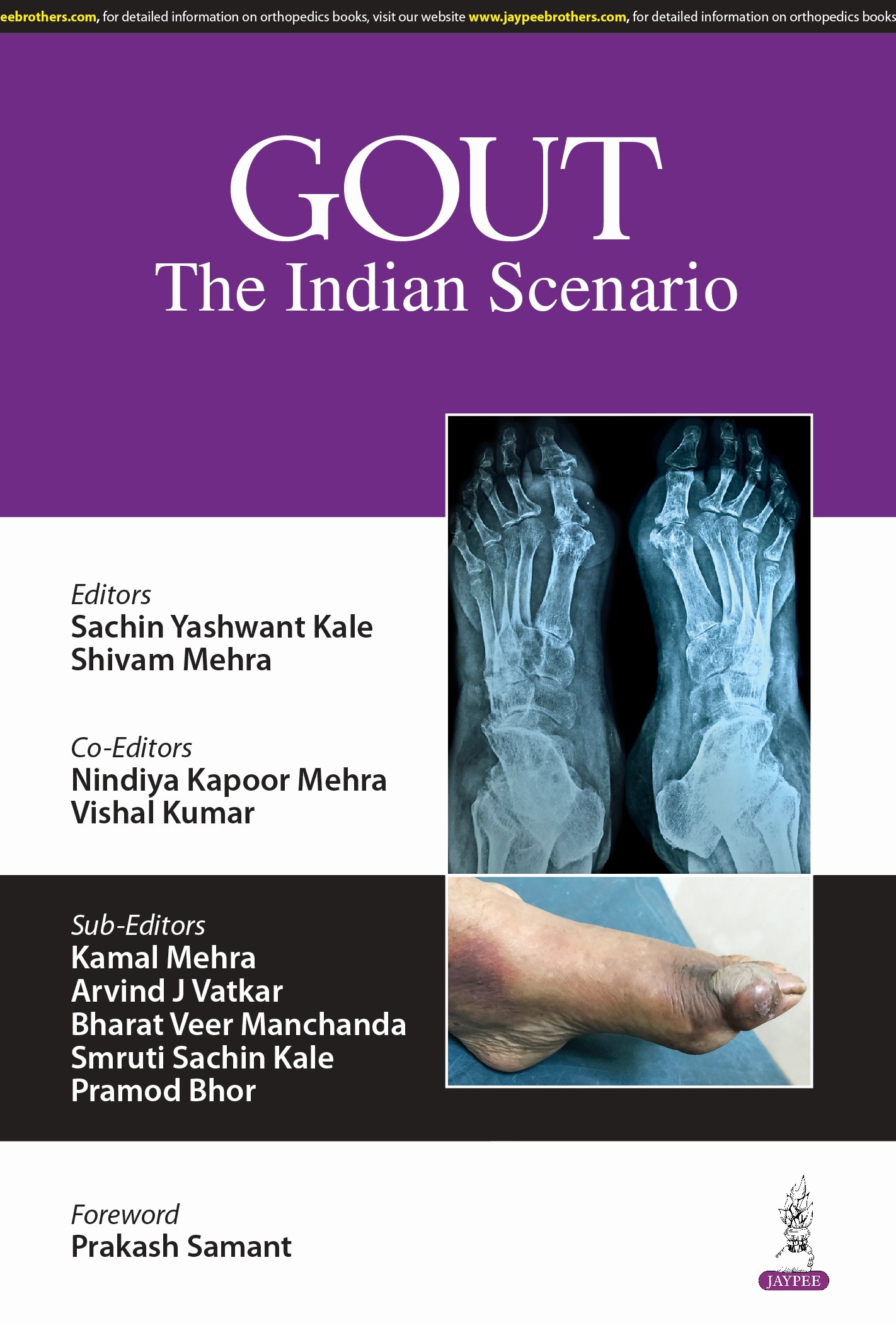 Gout: The Indian Scenario