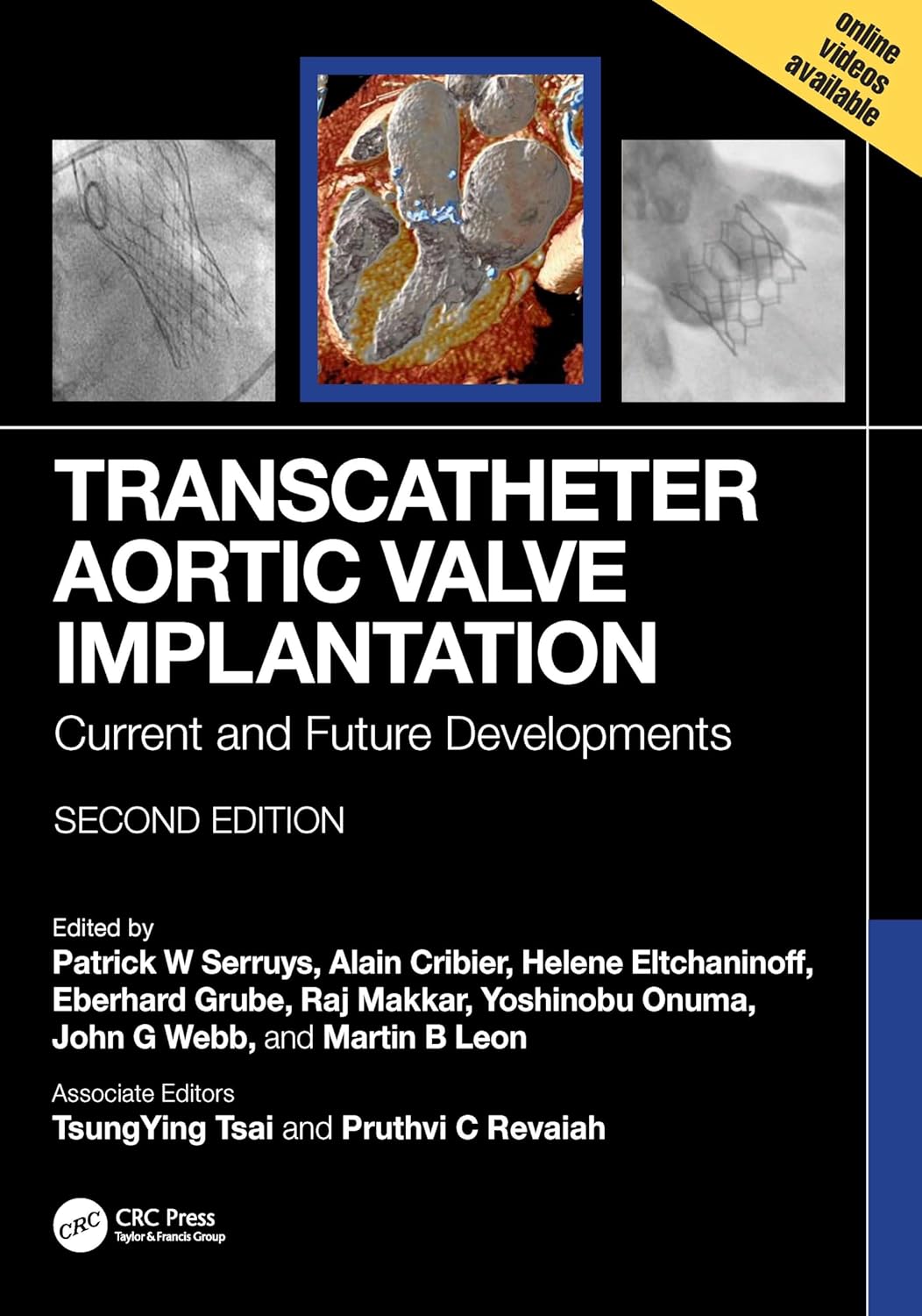 Transcatheter Aortic Valve Implantation Current And Future Developments 2Ed (Hb 2025)