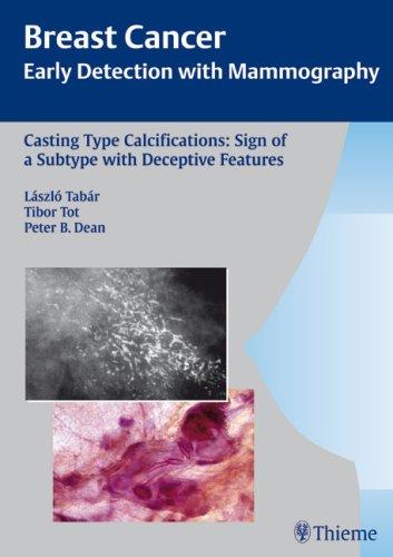 Casting Type Calcifications