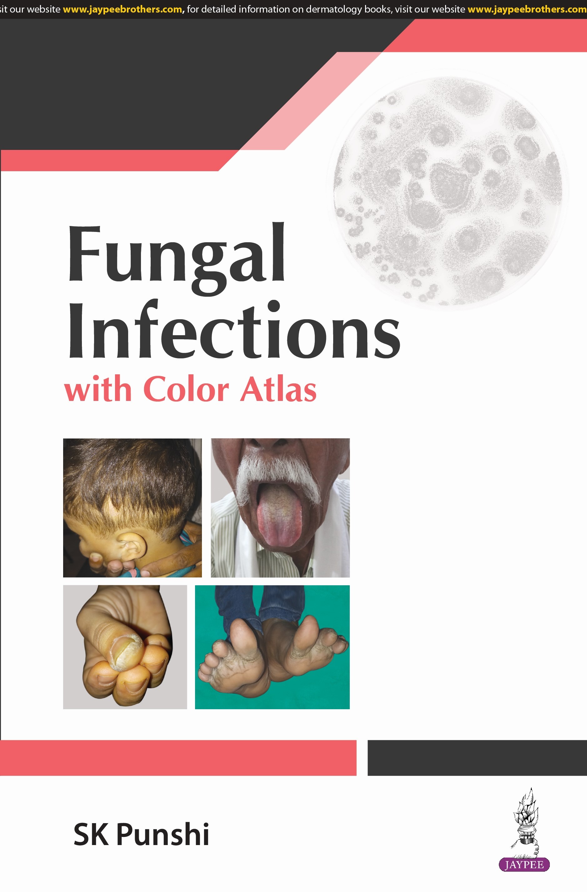 Fungal Infections With Color Altas