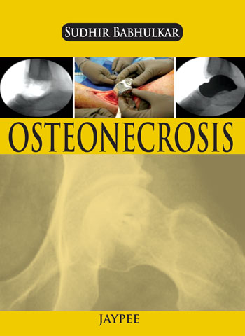 OSTEONECROSIS