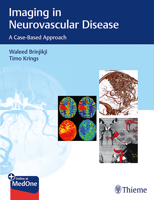 Imaging in Neurovascular Disease 1st Edition 2019