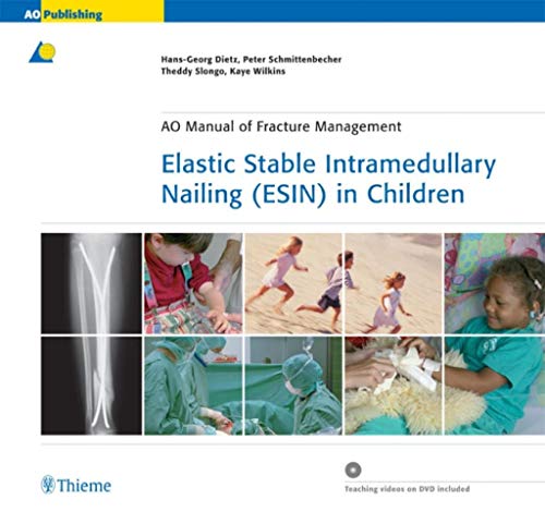 Elastic Stable Intramedullary Nailing (ESIN) in Ch 1st Edition 2006