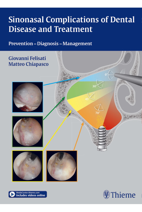 Cover of Sinonasal Complications of Dental Disease and Treatment 1st Edition 2015
