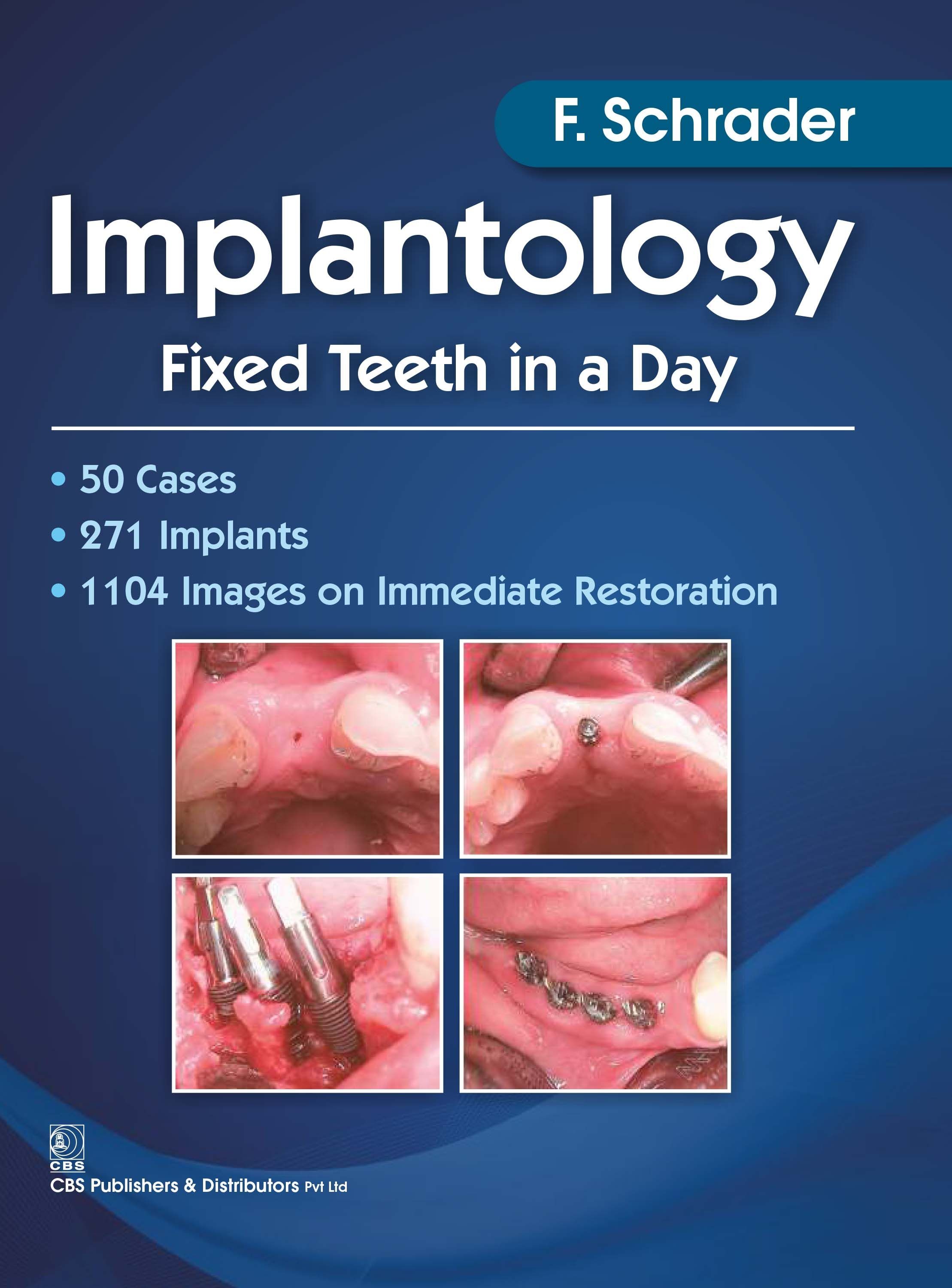 Cover of Implantology Fixed Teeth In A Day 1ST EDITION 2017