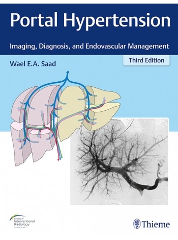 Portal Hypertension Imaging, Diagnosis, And Endovascular Management